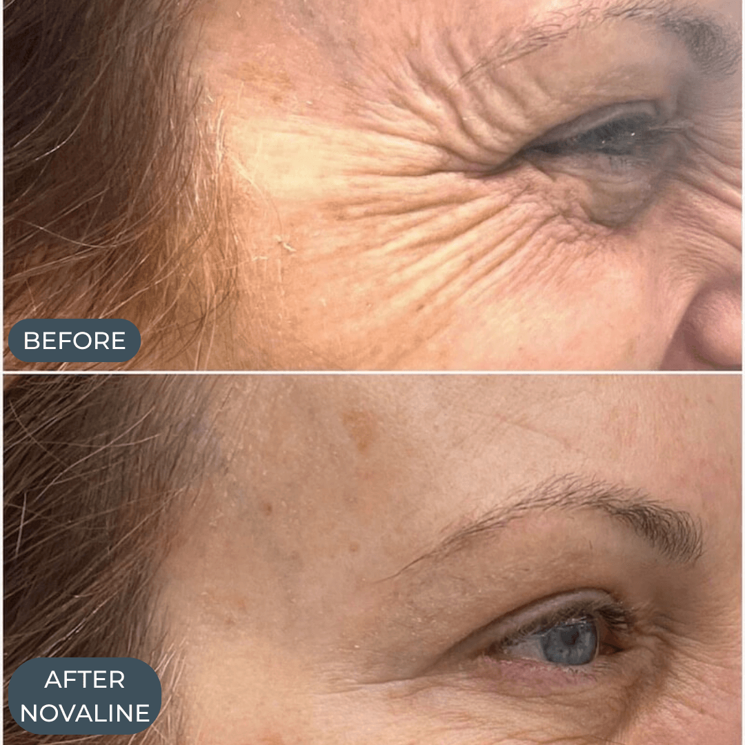 Novaline™ Anti-Aging Micro Infusion System
