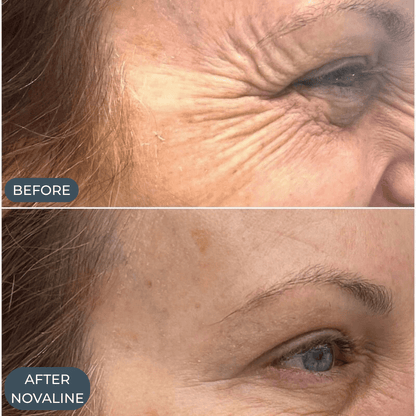 Novaline™ Anti-Aging Micro Infusion System