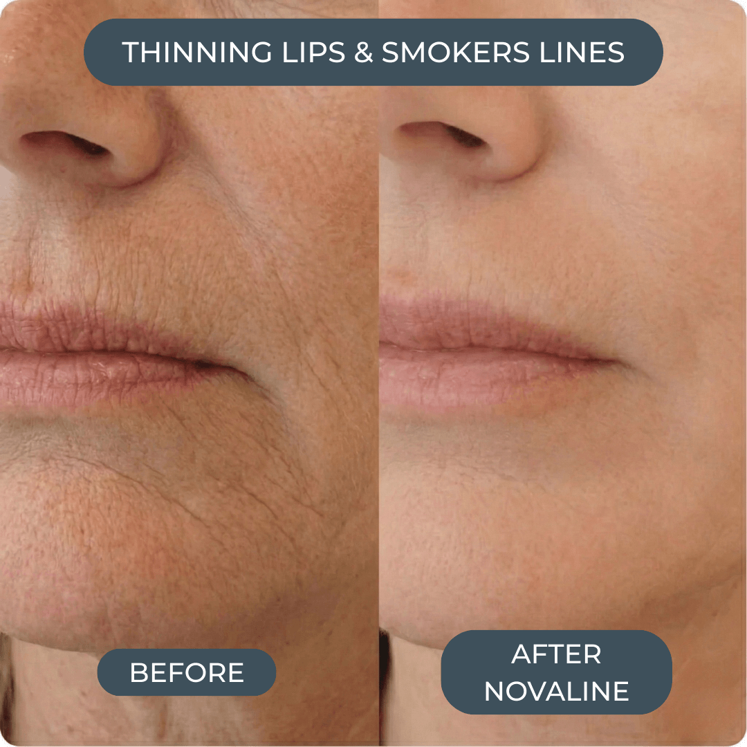 Novaline™ Anti-Aging Micro Infusion System