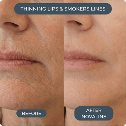 Novaline™ Anti-Aging Micro Infusion System