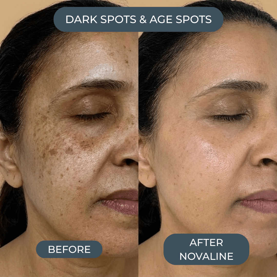 Novaline™ Anti-Aging Micro Infusion System