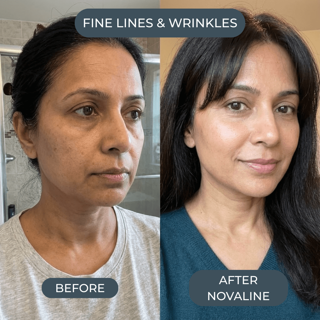 Novaline™ Anti-Aging Micro Infusion System
