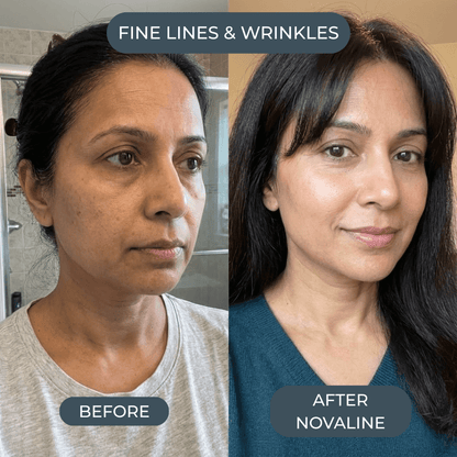 Novaline™ Anti-Aging Micro Infusion System