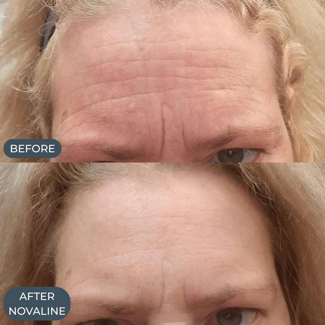 Novaline™ Anti-Aging Micro Infusion System