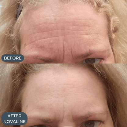 Novaline™ Anti-Aging Micro Infusion System